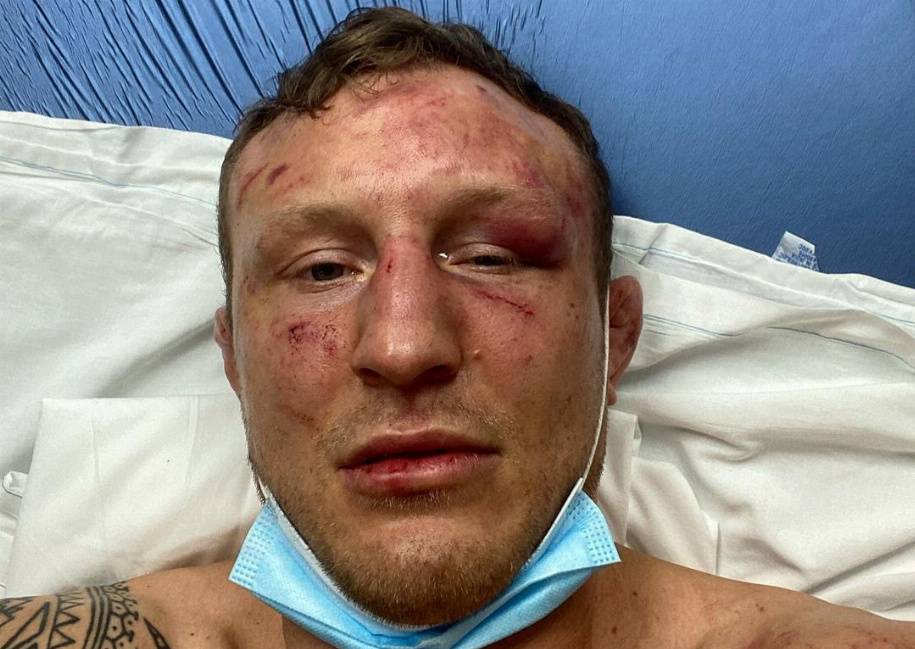 У бойца UFC после последнего боя переломы глазницы и пальца